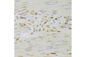 Immunohistochemistry of paraffin-embedded human gastric cancer using PRPF3 Antibody. (PRPF3 anticorps  (AA 1-280))