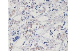 Immunohistochemistry of paraffin-embedded Human breast cancer using DNMT1 Polyclonal Antibody at dilution of 1:200 (40x lens). (DNMT1 anticorps)