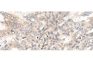 Immunohistochemistry of paraffin-embedded Human liver cancer tissue using CHRD Polyclonal Antibody at dilution of 1:40(x200)