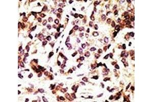 IHC analysis of FFPE human breast carcinoma tissue stained with the Beclin 1 antibody (Beclin 1 anticorps  (AA 181-210))