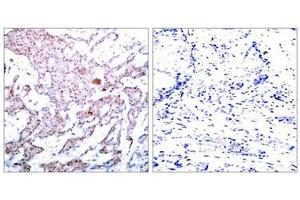 Immunohistochemical analysis of paraffin-embedded human breast carcinoma tissue using NFκB-p65 (Phospho-Ser536) Antibody (left) or the same antibody preincubated with blocking peptide (right).