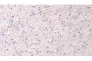 Detection of PANK4 in Human Glioma Tissue using Polyclonal Antibody to Pantothenate Kinase 4 (PANK4)