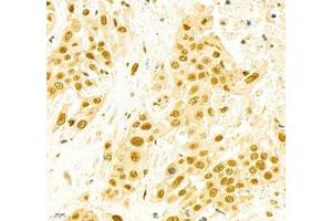 Immunohistochemistry of paraffin embedded human colon cancer using EFTUD2 (ABIN7073810) at dilution of 1: 2400 (400x lens) (EFTUD2 anticorps)