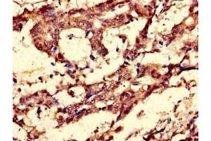 Immunohistochemistry of paraffin-embedded human gastric cancer using ABIN7148838 at dilution of 1:100 (Cyclin C anticorps  (AA 240-283))