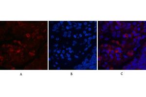Immunofluorescence analysis of human lung cancer tissue. (MAP1LC3A anticorps)