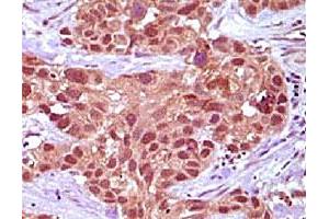 Immunohistochemical analysis of paraffin-embedded human rectum carcinoma tissue, showing nuclear and cytoplasmic localization using MSH2 monoclonal antibody, clone 3A2B8C  with DAB staining. (MSH2 anticorps)