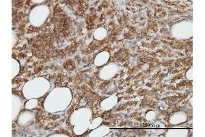 Immunoperoxidase of monoclonal antibody to CAMK2B on formalin-fixed paraffin-embedded human malignant lymphoma, diffuse large B.