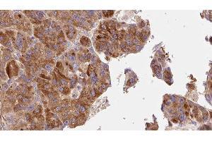 ABIN6277647 at 1/100 staining Human liver cancer tissue by IHC-P. (TACR1 anticorps  (Internal Region))