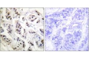Immunohistochemistry analysis of paraffin-embedded human breast carcinoma tissue, using Lamin A/C (Ab-392) Antibody. (Lamin A/C anticorps  (AA 361-410))