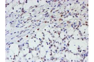 Immunohistochemical staining of paraffin-embedded Carcinoma of Human kidney tissue using anti-MLF1 mouse monoclonal antibody. (MLF1 anticorps)