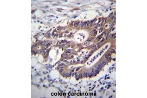 KRT12 Antibdy (C-term) immunohistochemistry analysis in formalin fixed and paraffin embedded human colon carcinoma followed by peroxidase conjugation of the secondary antibody and DAB staining. (KRT12 anticorps  (C-Term))