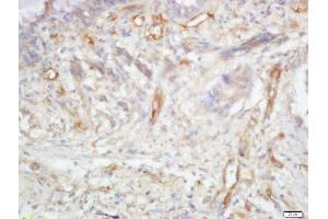 Formalin-fixed and paraffin embedded human lung cancer labeled with Anti-TRIB2 Polyclonal Antibody, Unconjugated  at 1:200 followed by conjugation to the secondary antibody and DAB staining (TRIB2 anticorps  (AA 151-250))
