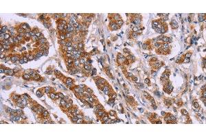 Immunohistochemistry of paraffin-embedded Human breast cancer tissue using DCTN6 Polyclonal Antibody at dilution 1:40