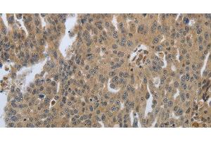 Immunohistochemistry of paraffin-embedded Human ovarian cancer tissue using PTPRT Polyclonal Antibody at dilution 1:30
