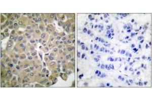 Immunohistochemistry analysis of paraffin-embedded human breast carcinoma tissue, using MART-1 Antibody. (MLANA anticorps  (AA 41-90))