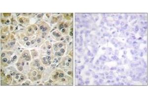Immunohistochemistry analysis of paraffin-embedded human breast carcinoma tissue, using Vimentin Antibody. (Vimentin anticorps  (AA 411-460))