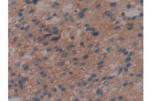 DAB staining on IHC-P; Samples: Human Glioma Tissue (IL29 anticorps  (AA 20-200))