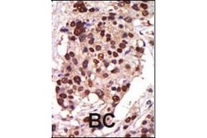 Formalin-fixed and paraffin-embedded human cancer tissue reacted with the primary antibody, which was peroxidase-conjugated to the secondary antibody, followed by AEC staining. (PRKD3 anticorps  (AA 352-384))