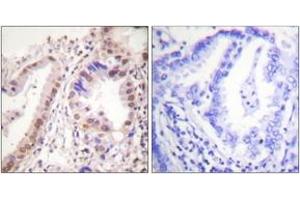 Immunohistochemistry analysis of paraffin-embedded human lung carcinoma tissue, using Estrogen Receptor-alpha (Ab-537) Antibody. (Estrogen Receptor alpha anticorps  (AA 501-550))