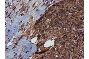 Immunohistochemical staining of paraffin-embedded Adenocarcinoma of Human breast tissue using anti-C1S mouse monoclonal antibody. (C1S anticorps)