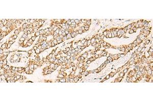 Immunohistochemistry of paraffin-embedded Human liver cancer tissue using COX6C Polyclonal Antibody at dilution of 1:25(x200) (COX6C anticorps)
