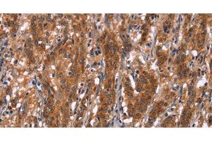 Immunohistochemistry of paraffin-embedded Human gastric cancer tissue using GPHN Polyclonal Antibody at dilution 1:30 (Gephyrin anticorps)