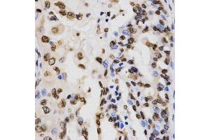 Immunohistochemistry of paraffin-embedded human lung cancer using TriMethyl-Histone H3-K9 antibody. (Histone 3 anticorps  (H3K9me3))