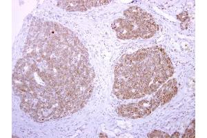 IHC-P Image tPA antibody detects tPA protein at cytoplasm on human colon carcinoma by immunohistochemical analysis. (PLAT anticorps)