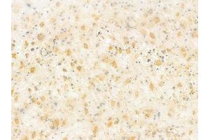 Ephrin B1/B2/B3 Antibody at 1/100 staining human astrocytoma by IHC-P. (Ephrin B1/B2/B3 (EFNB1/2/3) anticorps)