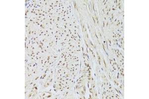 Immunohistochemistry of paraffin-embedded human adenomyosis using SNRPA Antibody. (SNRPA1 anticorps  (AA 1-282))
