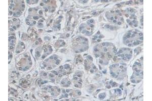 IHC-P analysis of Human Pancreas Cancer Tissue, with DAB staining. (ERK1 anticorps  (AA 75-312))