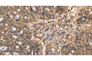 Immunohistochemistry of paraffin-embedded Human ovarian cancer tissue using HK3 Polyclonal Antibody at dilution 1:40 (HK3 anticorps)