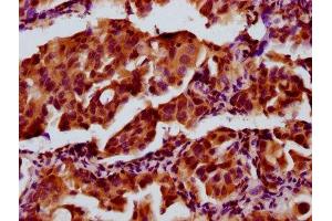 IHC image of ABIN7143405 diluted at 1:300 and staining in paraffin-embedded human lung cancer performed on a Leica BondTM system.