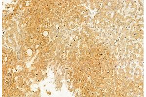 ABIN6265507 and ABIN6272873 at 1/100 staining Human esophageal cancer by IHC-P. (TCTN1 anticorps  (N-Term))