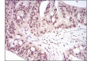 Immunohistochemical analysis of paraffin-embedded rectum cancer tissues using HSF1 mouse mAb with DAB staining.