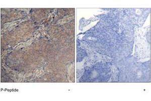 Imunohistochemical analysis of paraffin-embedded human breast carcinoma tissue, using MYL2 (phospho S19) polyclonal antibody . (MYL12A anticorps  (pSer18))