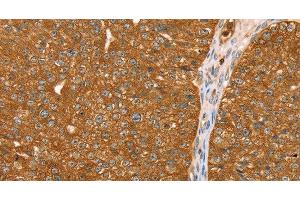 Immunohistochemistry of paraffin-embedded Human breast cancer tissue using ABCC8 Polyclonal Antibody at dilution 1:40 (ABCC8 anticorps)