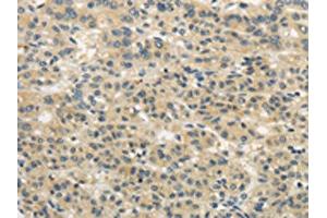 The image on the left is immunohistochemistry of paraffin-embedded Human liver cancer tissue using ABIN7193043(WDR91 Antibody) at dilution 1/20, on the right is treated with synthetic peptide. (WDR91 anticorps)