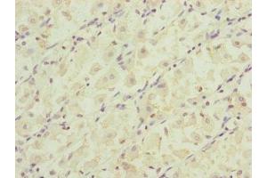 Immunohistochemistry of paraffin-embedded human gastric cancer using ABIN7164323 at dilution of 1:100