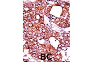 Formalin-fixed and paraffin-embedded human cancer tissue reacted with the primary antibody, which was peroxidase-conjugated to the secondary antibody, followed by AEC staining.