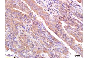 Formalin-fixed and paraffin embedded human breast cancer labeled with Rabbit Anti CA153/EMA/Mucin 1 Polyclonal Antibody, Unconjugated (ABIN673824) at 1:200 followed by conjugation to the secondary antibody and DAB staining (MUC1 anticorps  (AA 1051-1255))