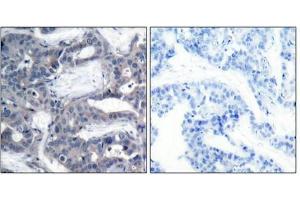 Immunohistochemical analysis of paraffin-embedded human breast carcinoma tissue using MEK-2(Phospho-Thr394) Antibody(left) or the same antibody preincubated with blocking peptide(right).