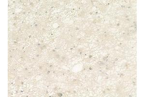 ABIN6264926 and ABIN6279887 at 1/100 staining human astrocytoma by IHC-P.