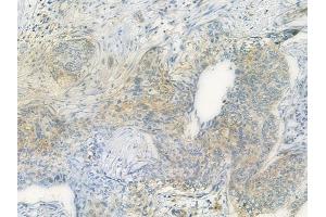 ABIN6259034 and ABIN6275060 at 1/100 staining human cervical carcinoma by IHC-P. (DHODH anticorps  (Internal Region))