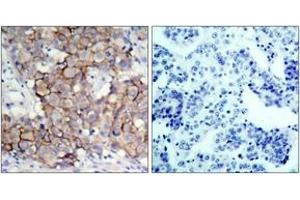 Immunohistochemistry analysis of paraffin-embedded human breast carcinoma, using HER2 (Phospho-Tyr877) Antibody. (ErbB2/Her2 anticorps  (pTyr877))