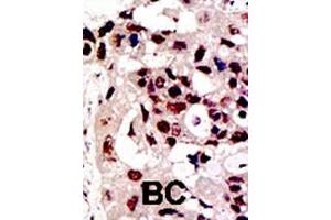 Formalin-fixed and paraffin-embedded human cancer tissue reacted with the primary antibody, which was peroxidase-conjugated to the secondary antibody, followed by DAB staining.