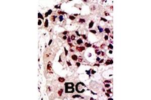 Formalin-fixed and paraffin-embedded human cancer tissue reacted with the primary antibody, which was peroxidase-conjugated to the secondary antibody, followed by DAB staining. (PIAS3 anticorps  (AA 588-619))