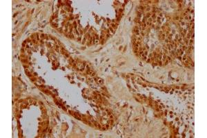 IHC image of ABIN7154883 diluted at 1:256 and staining in paraffin-embedded human prostate cancer performed on a Leica BondTM system.