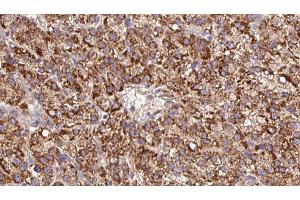 ABIN6279609 at 1/100 staining Human liver cancer tissue by IHC-P. (CHRNB3 anticorps  (Internal Region))