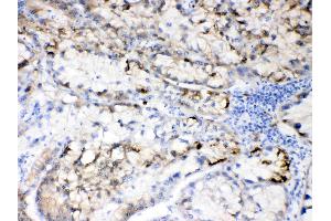 Hepatitis B Virus was detected in paraffin-embedded sections of human liver cancer tissues using rabbit anti- Hepatitis B Virus Antigen Affinity purified polyclonal antibody (Catalog # ) at 1 µg/mL. (HBV Large S Protein anticorps  (N-Term))